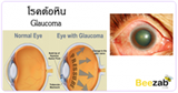 โรคต้อหิน โรคตา ตาต้อ โรคเกี่ยวกับดวงตา