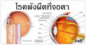 พังผืดที่จอตา โรคตา โรคไม่ติดต่อ รักษาพังผืดที่ตา