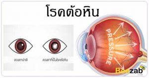 ต้อหิน โรคตา โรคไม่ติดต่อ รักษาตาต้อ