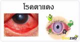 โรคตาแดง ดวงตาอักเสบ โรคตา โรคติดต่อ