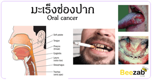 มะเร็งช่องปาก โรคมะเร็ง โรคในช่องปาก เป็นมะเร็งช่องปาก