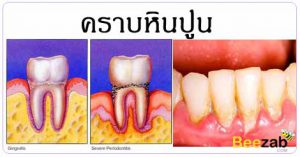 คราบหินปูน โรคในช่องปาก โรคไม่ติดต่อ โรคเกี่ยวกับฟัน