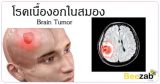 โรคเนื้องอกในสมอง เนื้องอกในสมอง โรคสมอง โรคระบบประสาทและสมอง