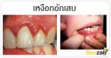 โรคเหงือกอักเสบ โรคในช่องปาก โรคเหงือก ปวดเหงือก