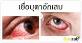 เยื่อบุตาอักเสบ ตาแดง โรคตา โรคติดเชื้อ