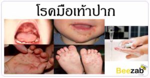 โรคมือเท้าปาก โรคติดต่อ โรคเด็ก โรคติดเชื้อ