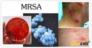 mRSA ติดเชื้อแบคทีเรียสแตฟฟิโลคอกคัส Staphylococcus aureus 